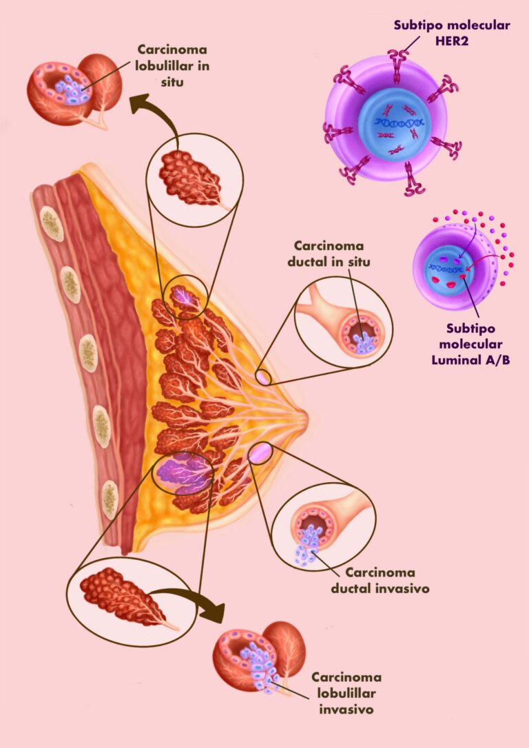 Ilustración carcinoma