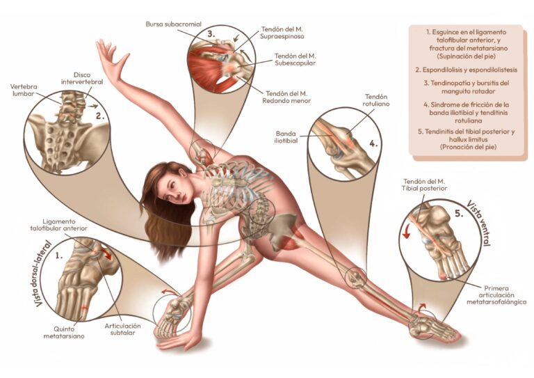 Lesiones en danza contemporánea